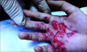 Obrażenia po oparzeniach spowodowanych kontaktem skóry z suchym lodem (źródło: gizmodo.com)